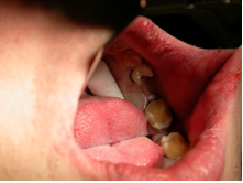 подготовка зубов под протез без обточки